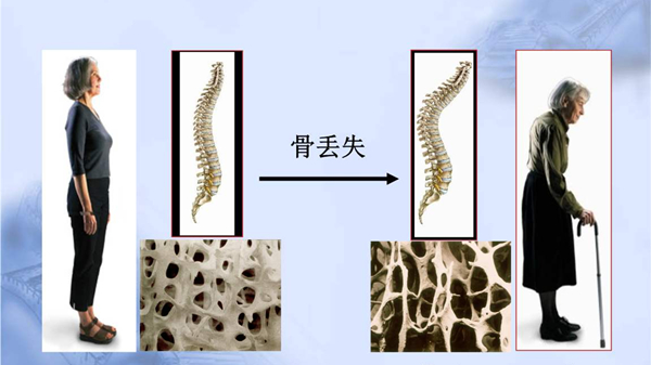 出现这些症状，成都金牛区养老院一暄康养提醒您可能有骨质疏松！-身体短缩，出现驼背