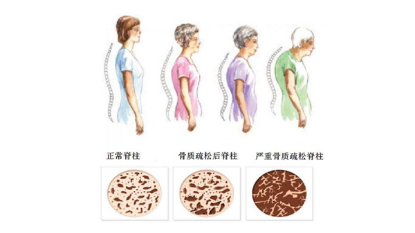 出现这些症状，成都养老院一暄康养提醒您可能有骨质疏松！-胸闷气短，呼吸困难