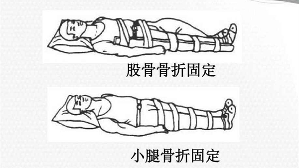 成都养老院一暄康养分享骨折急救小知识之急救措施篇-包扎固定