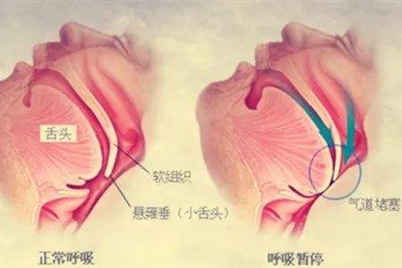 成都养老院经验分享：经常打鼾危害多，治疗妙招看一暄（二）1