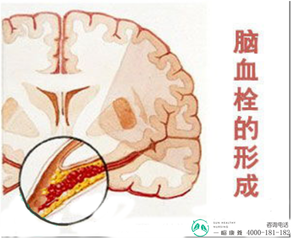 成都养老院脑血栓的形成