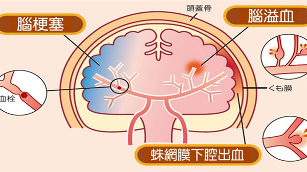 成都康养结合养老院一暄康养为您解答中风患者的饮食禁忌