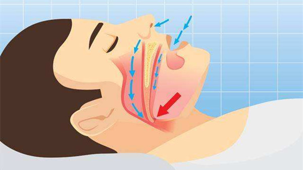 经常打鼾危害多，治疗妙招看一暄（三）
