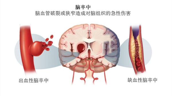 脑卒中