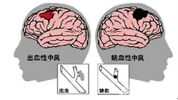 脑中风的这些常识，你了解多少？跟成都金牛区养老院一暄康养来学习学习-脑中风2