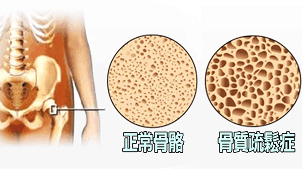 成都好的养老院一暄康养提醒高血脂的危害（一）-骨质疏松